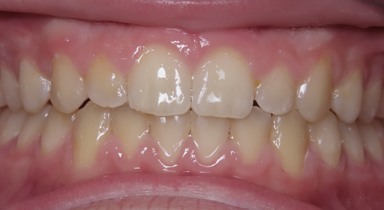 photo of teeth after braces