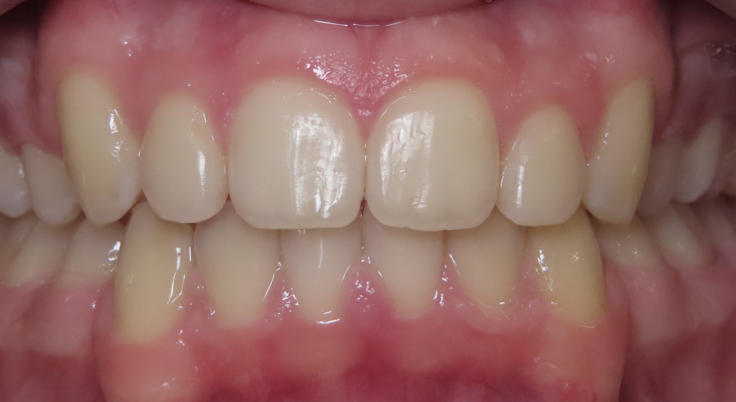 photo of teeth after braces